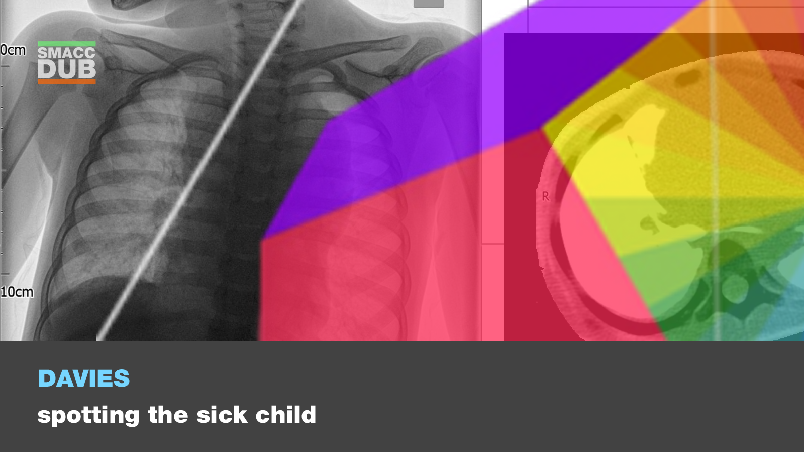 How to Spot the Sick Child in the Emergency Department